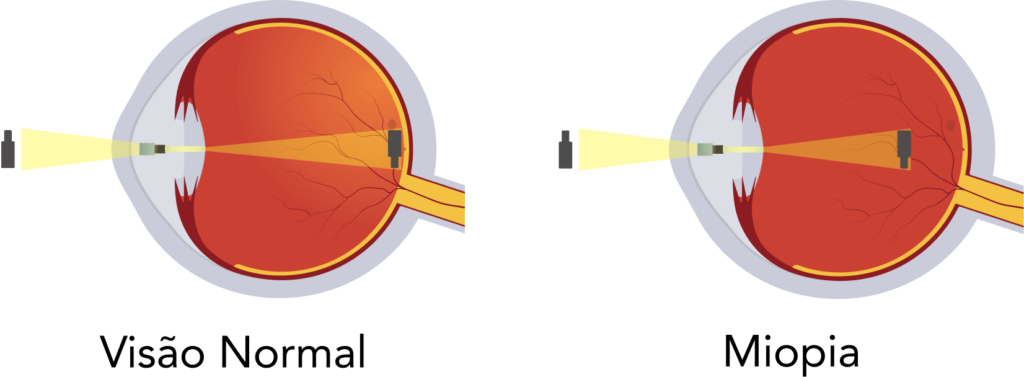 Ilustração de como a miopia funciona e afeta nossa visão