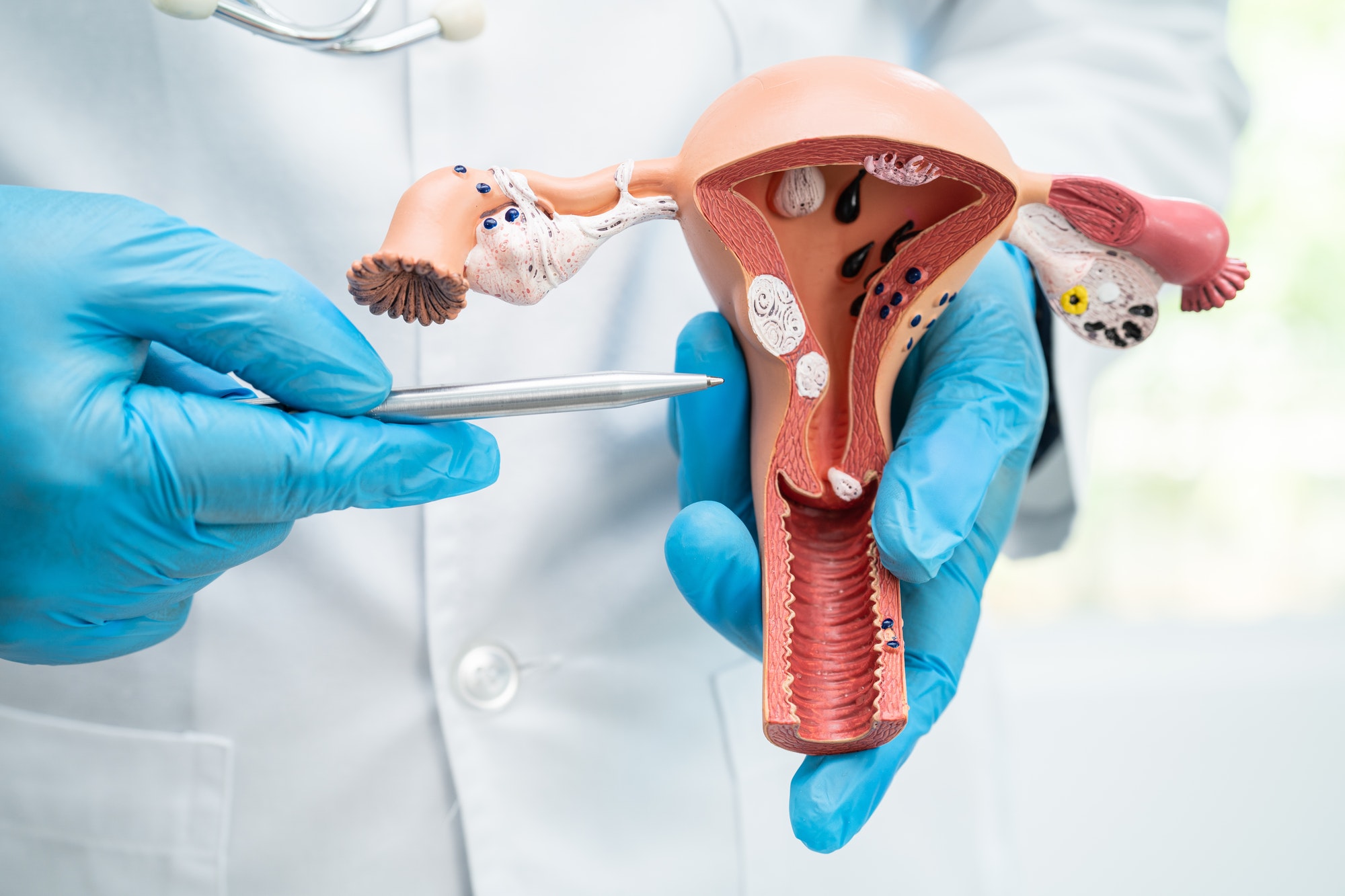 Inflamação no Útero