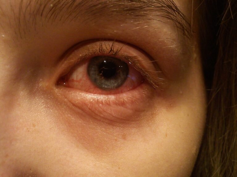 An up-close shot of an eye with the conjunctivitis disease.