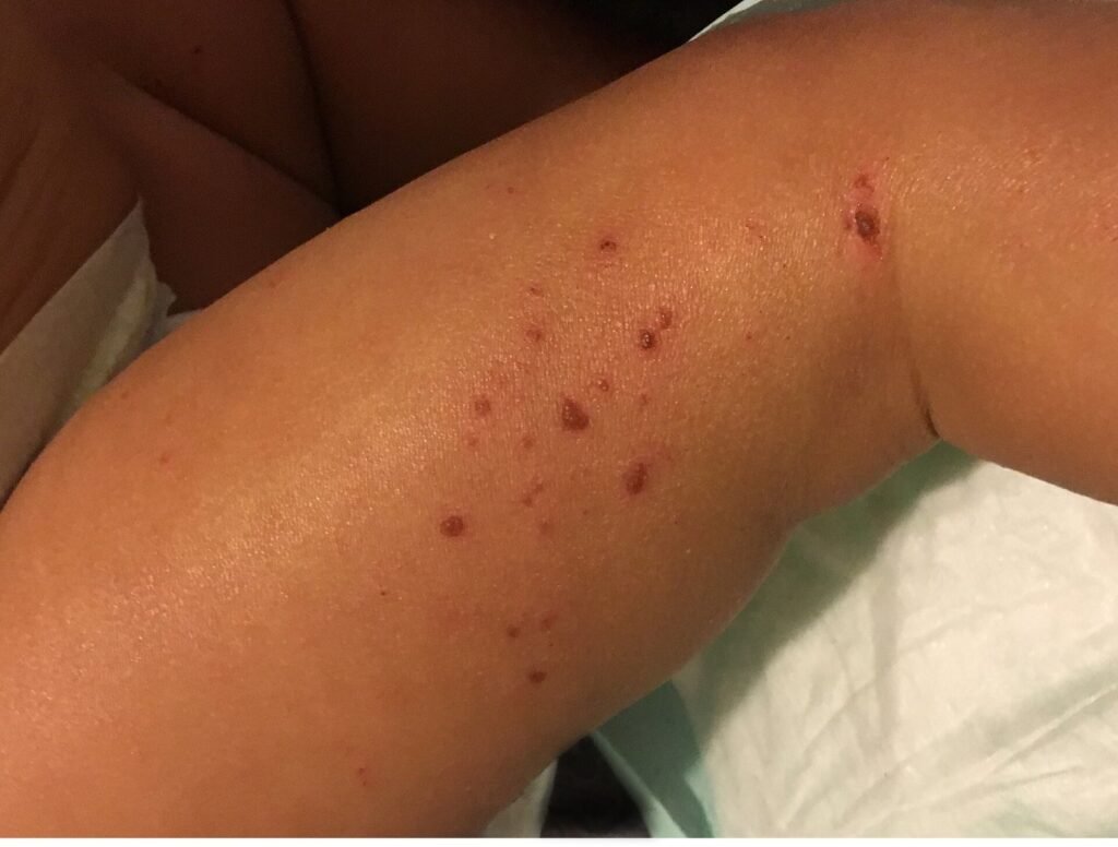 Dermatite atópica afeta sono e convívio social, além da pele